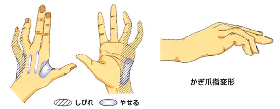 手根管症候群の症状